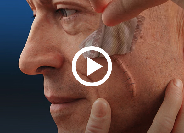 Mohs Surgery Post-op Video